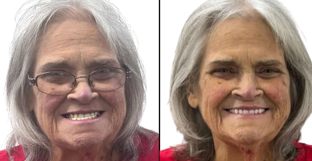 Before and Afters - all-on-4 Dental Implants
