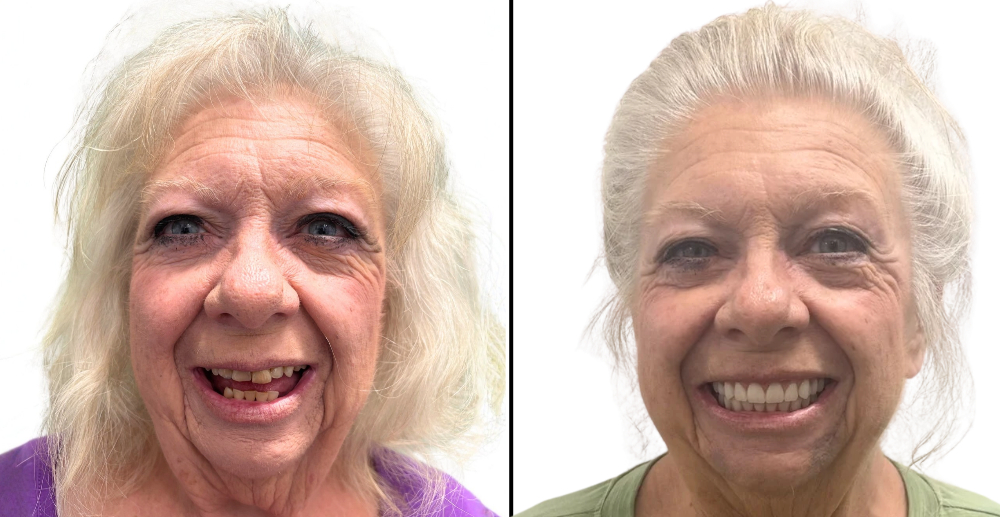 Before and Afters - all-on-4 dental implants yukon