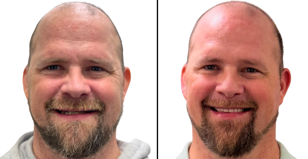Before and After Dental Implants