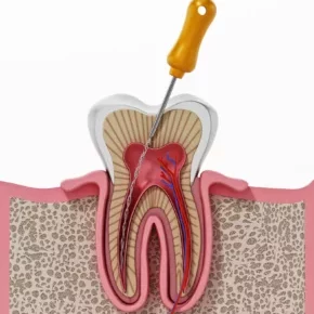 3d-illustration-root-canal-treatment-process 3d-illustration-root-canal-treatment-process