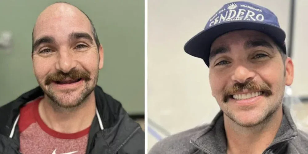 Before and After Dental Implants Male
