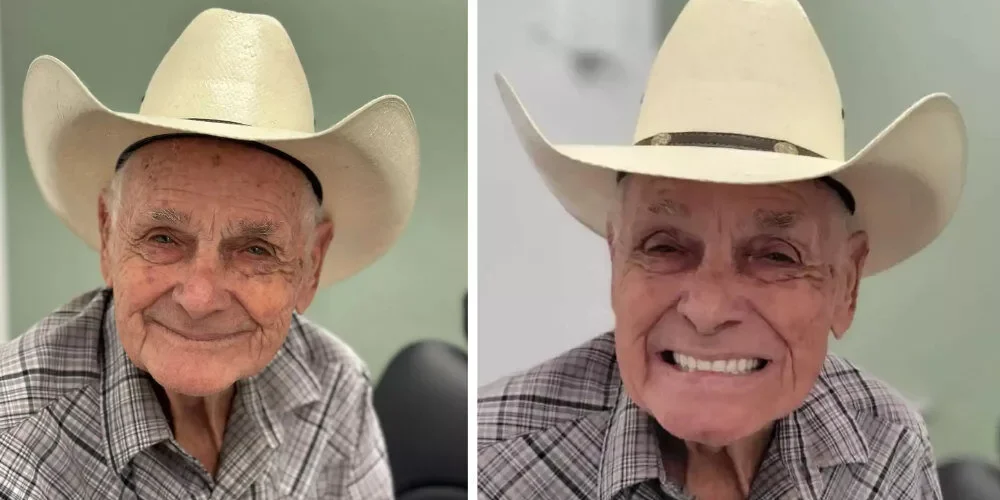 Before and After photo of Full Mouth All-on-4 dental implant patient