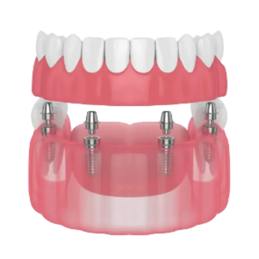 Fixed Full Arch