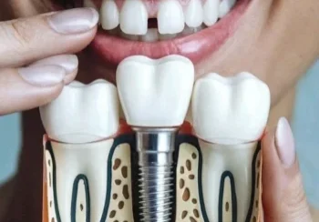 How Dental Implants Restore Smile Confidence