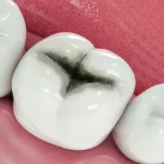 Tooth in need of dental overlay Tooth in need of dental overlay
