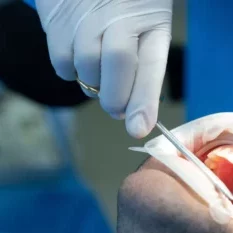 dentist-with-tool-applying-dental-sealant-on-back-molar Dentist applying dental sealant on back molar