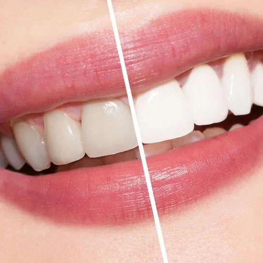 Patient smiling after professional teeth whitening Yukon OK treatment at dental clinic